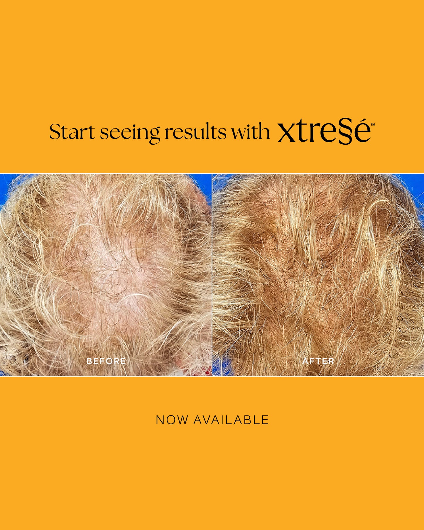 Xtressé