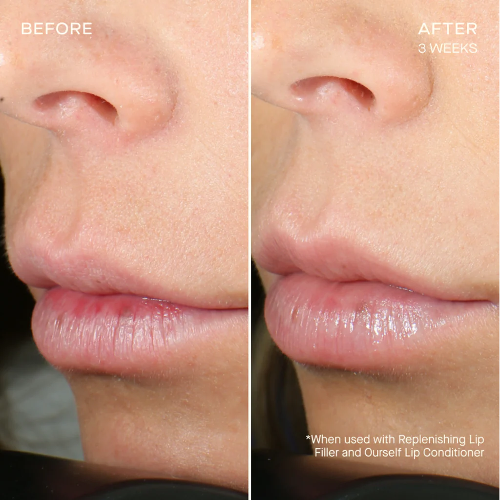 Ourself Lip Filler