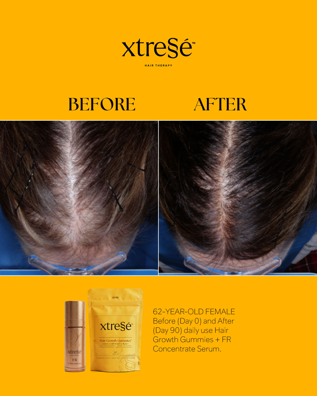 Xtressé