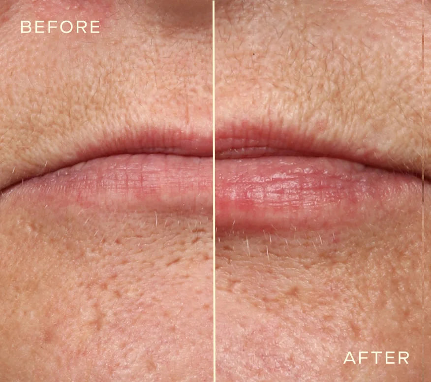 Ourself Lip Filler