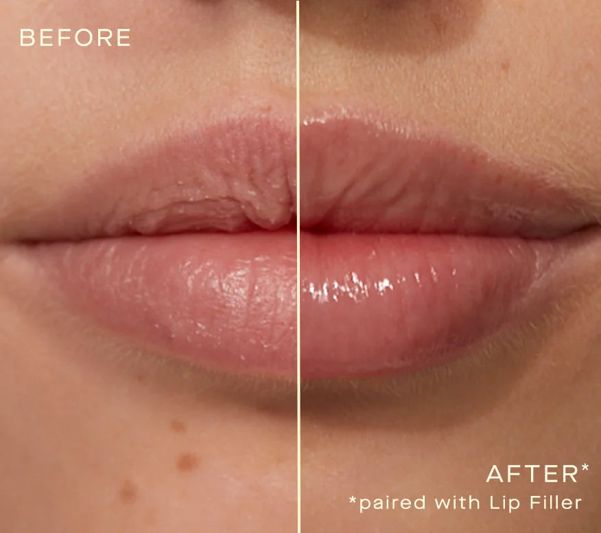Ourself Lip Filler