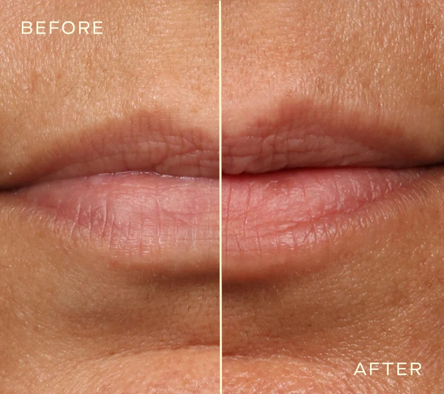 Ourself Lip Filler